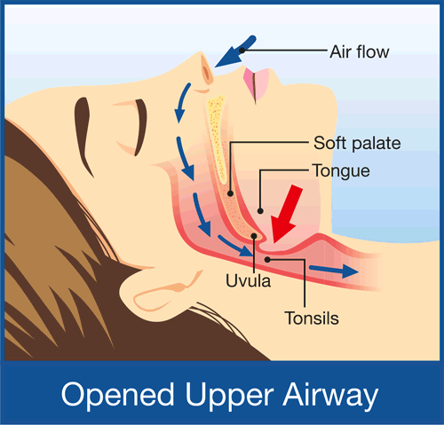 snoring-diagram snoring diagram